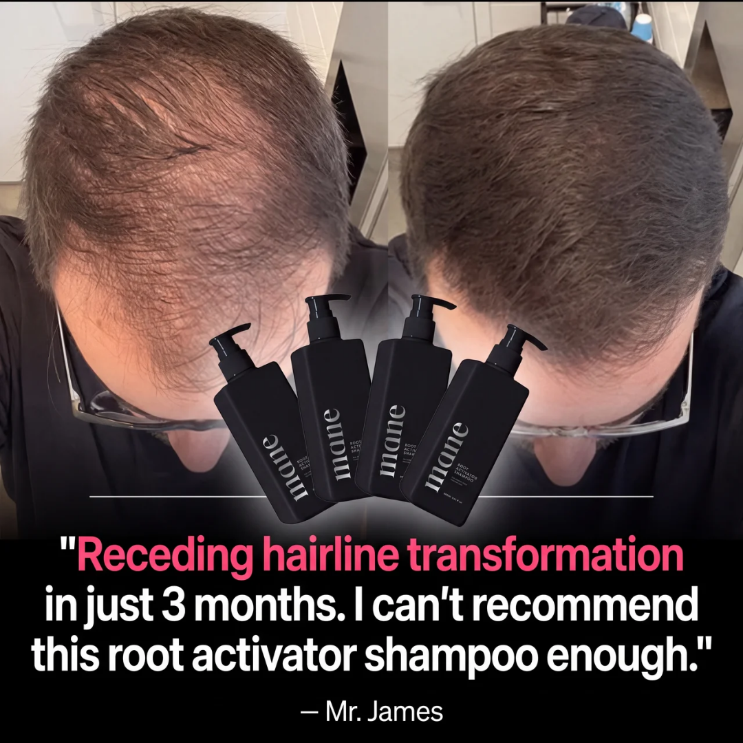 Mane ad — receding hairline transformation testimonial